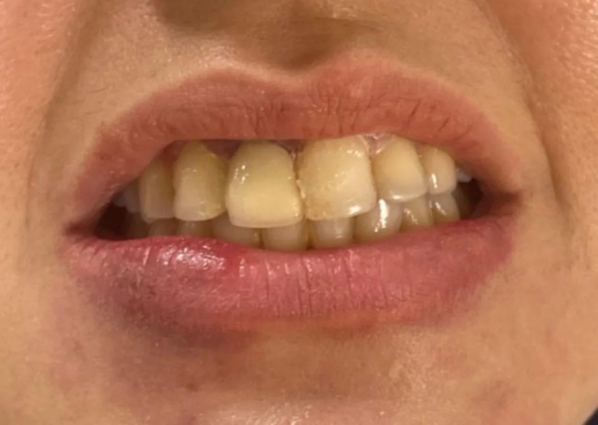 After Treatment Result - Front Tooth Gap & Dental Implant Restoration at Dentafusion Kota