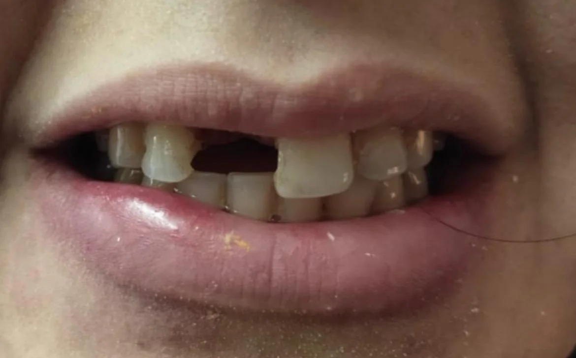 Before Treatment Condition - Front Tooth Gap & Dental Implant Restoration at Dentafusion Kota