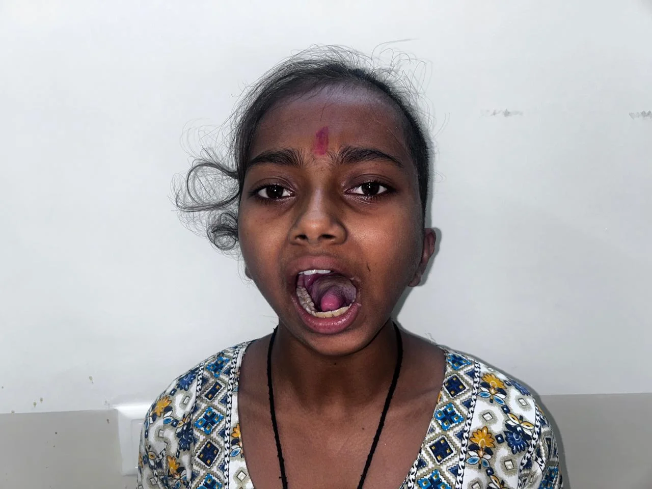 After Treatment Result - Pediatric Mandibular Posture & Oral Alignment at Dentafusion Kota