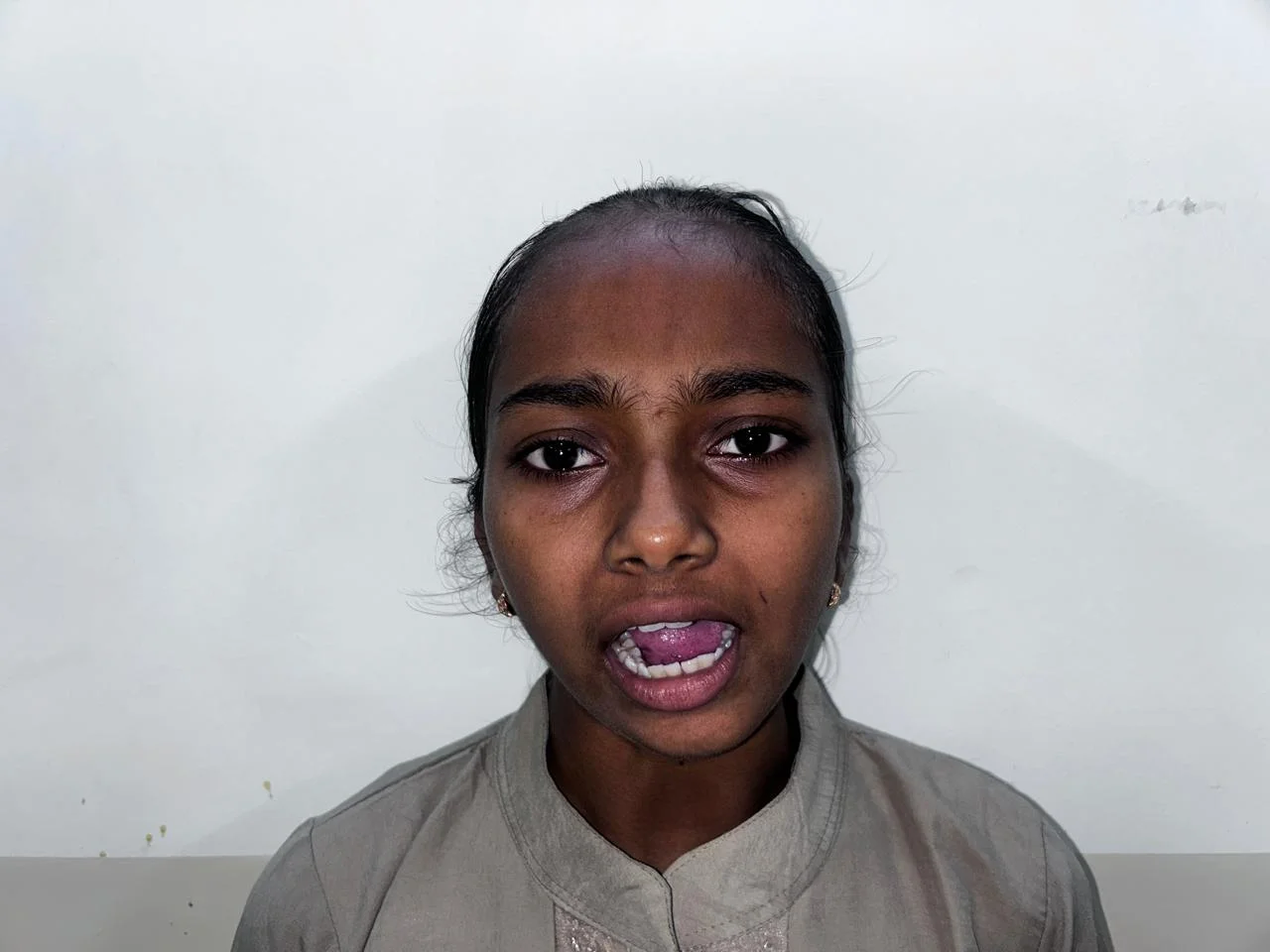 Before Treatment Condition - Pediatric Mandibular Posture & Oral Alignment at Dentafusion Kota