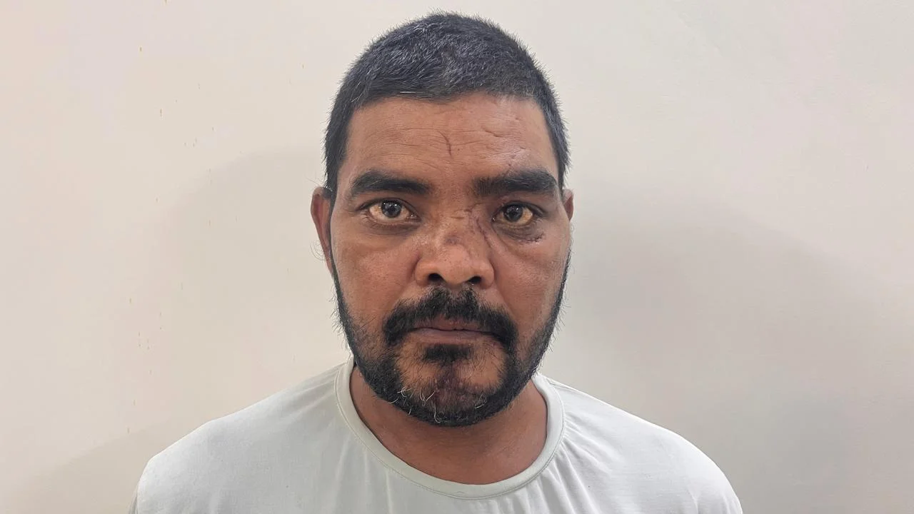 After Treatment Result - Facial Trauma & Soft Tissue Reconstruction at Dentafusion Kota