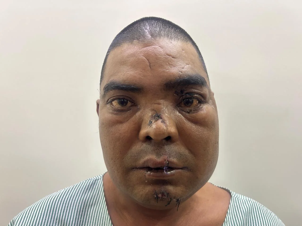 Before Treatment Condition - Facial Trauma & Soft Tissue Reconstruction at Dentafusion Kota