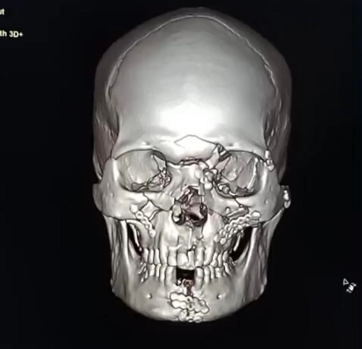 After Treatment Result - 3D Surgical Fixation of Panfacial Fractures at Dentafusion Kota