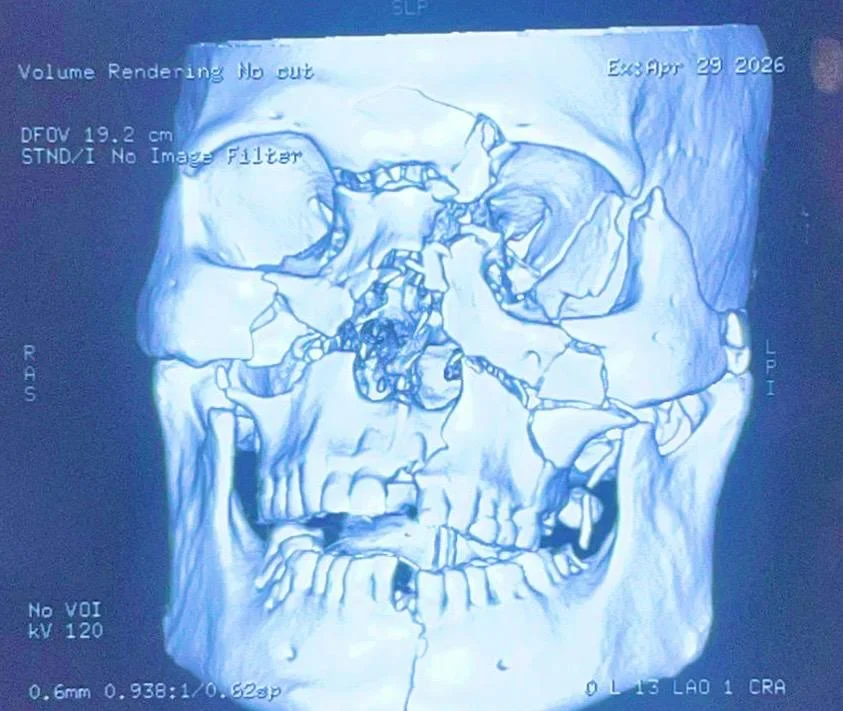 Before Treatment Condition - 3D Surgical Fixation of Panfacial Fractures at Dentafusion Kota