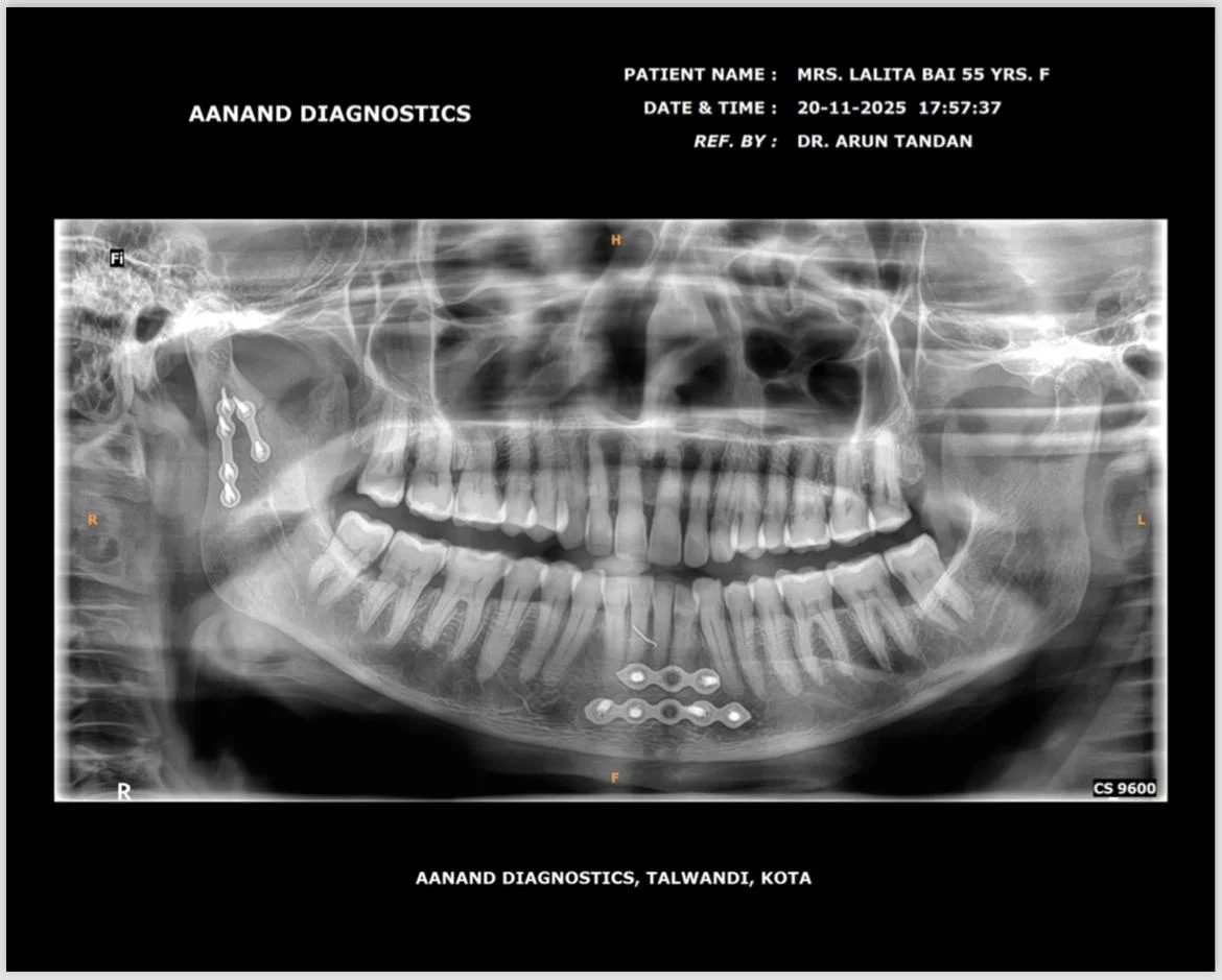 After Treatment Result - Mandibular Fracture Fixation with Titanium Plates at Dentafusion Kota
