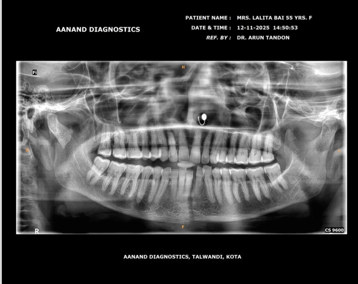 Before Treatment Condition - Mandibular Fracture Fixation with Titanium Plates at Dentafusion Kota