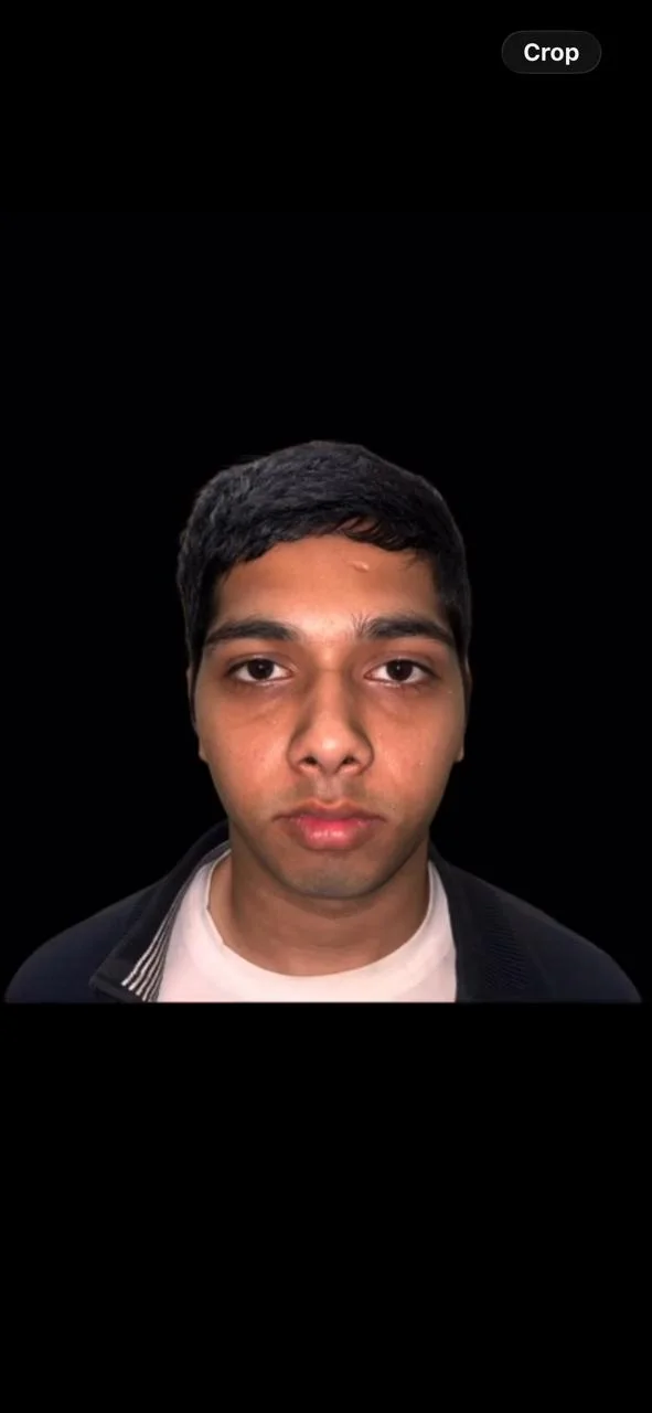 Before Treatment Condition - Facial Profile & Chin Alignment Realignment at Dentafusion Kota
