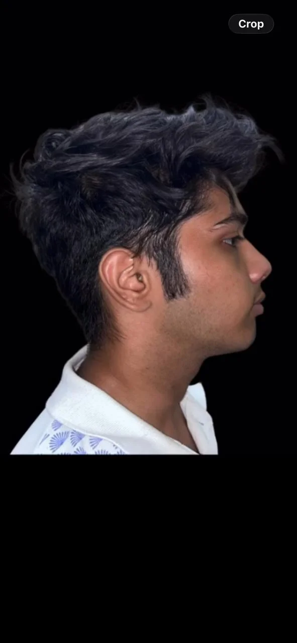 After Treatment Result - Profile Correction & Mandibular Advancement at Dentafusion Kota