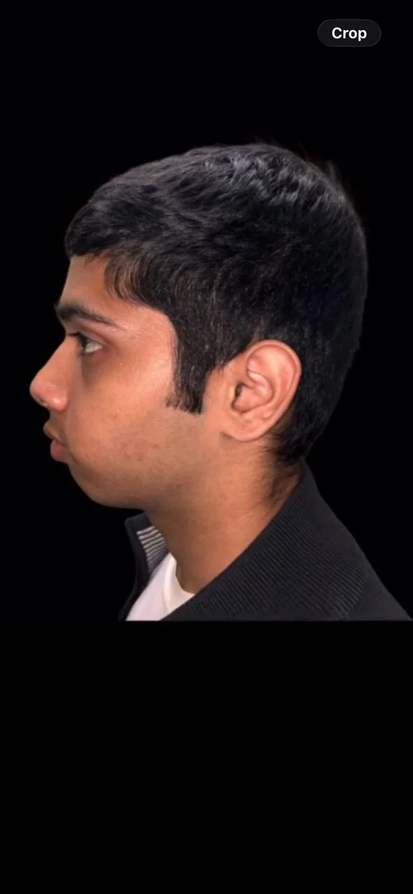 Before Treatment Condition - Profile Correction & Mandibular Advancement at Dentafusion Kota