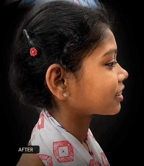 After Treatment Result - Forward-Placed Front Teeth Correction at Dentafusion Kota