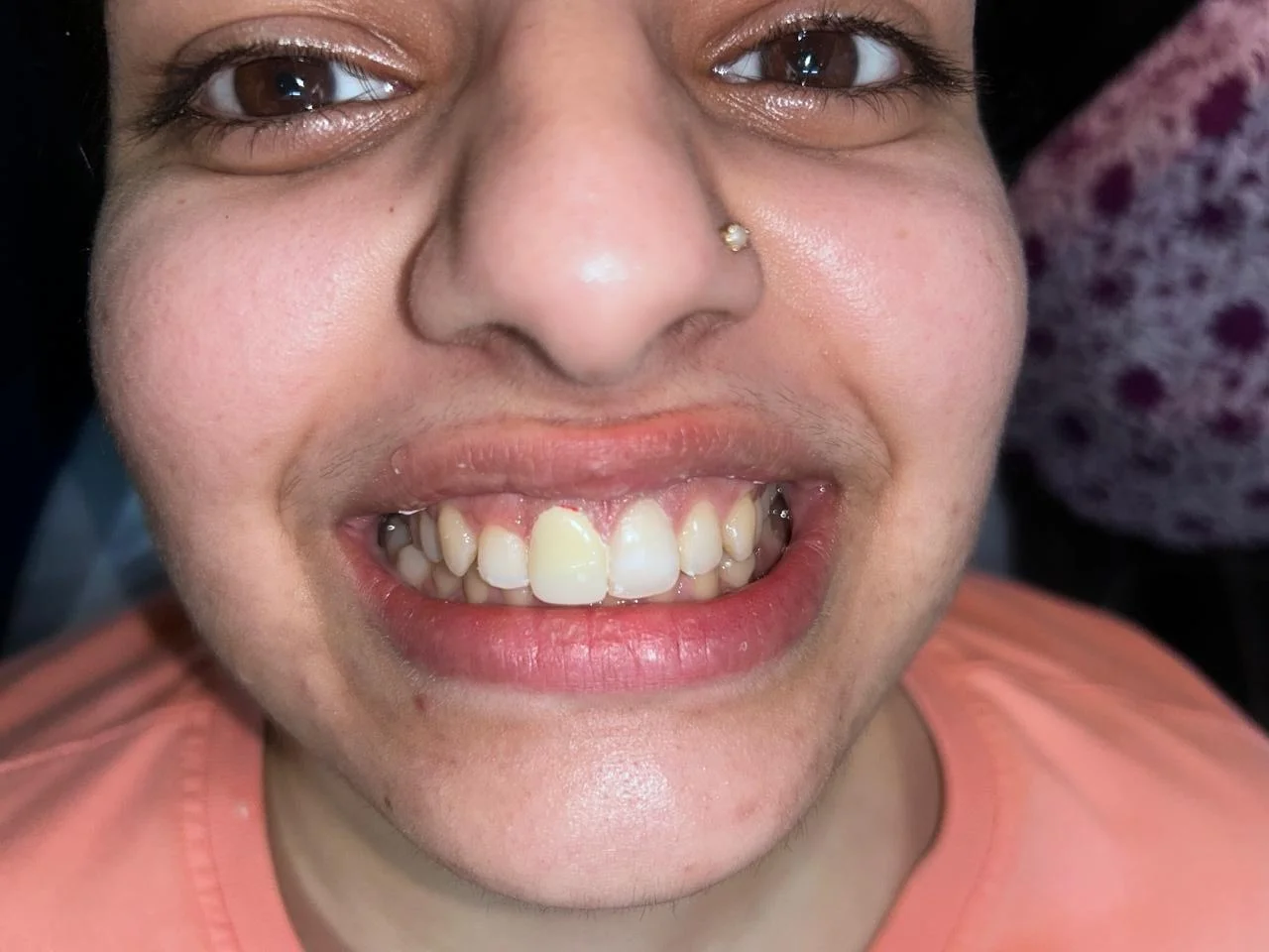 After Treatment Result - Aesthetic Correction of Fractured & Subluxated Anterior Tooth at Dentafusion Kota