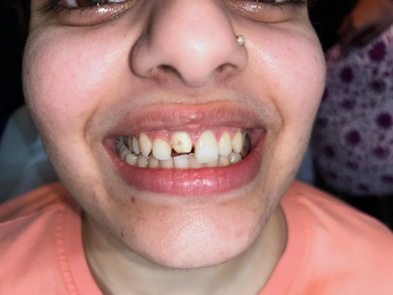 Before Treatment Condition - Aesthetic Correction of Fractured & Subluxated Anterior Tooth at Dentafusion Kota