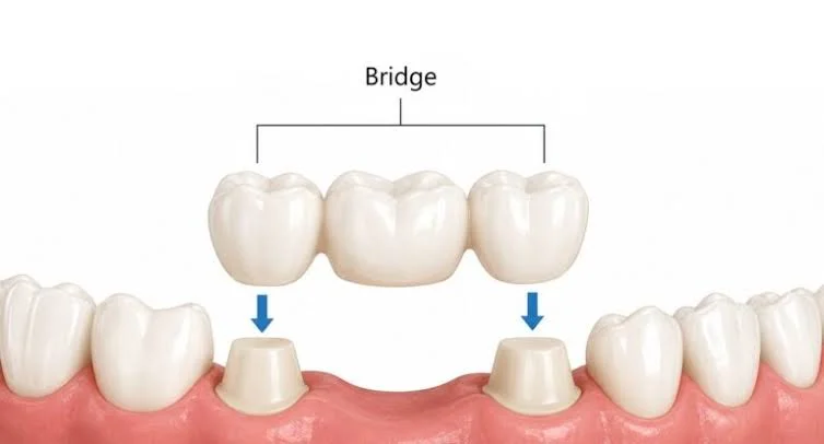 Crowns and Bridges in Kota - Dentafusion Dental Clinic