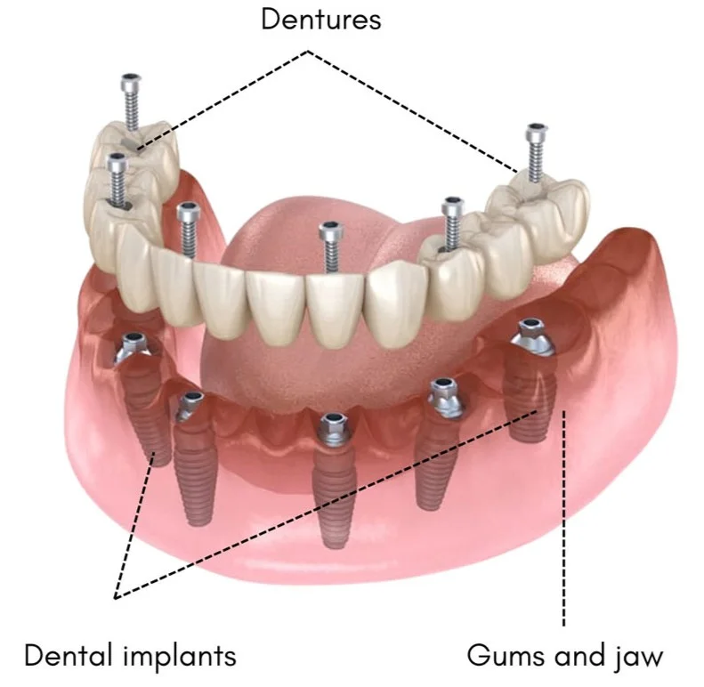 Dental Implants in Kota in Kota - Dentafusion Dental Clinic