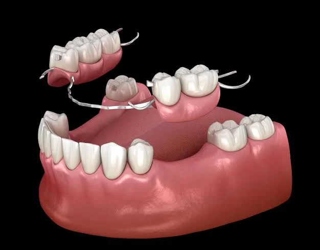Complete & Partial Dentures in Kota - Dentafusion Dental Clinic