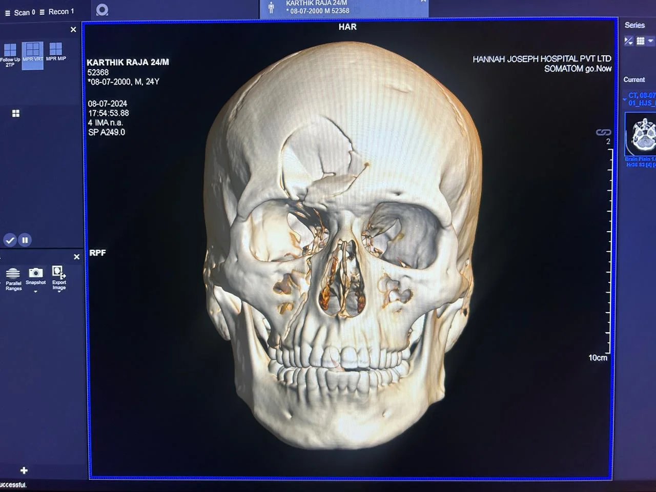Cranio-Facial Trauma Surgery in Kota - Dentafusion Dental Clinic