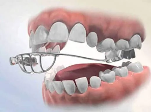 Kids Dentist & Habit Correction in Kota - Dentafusion Dental Clinic