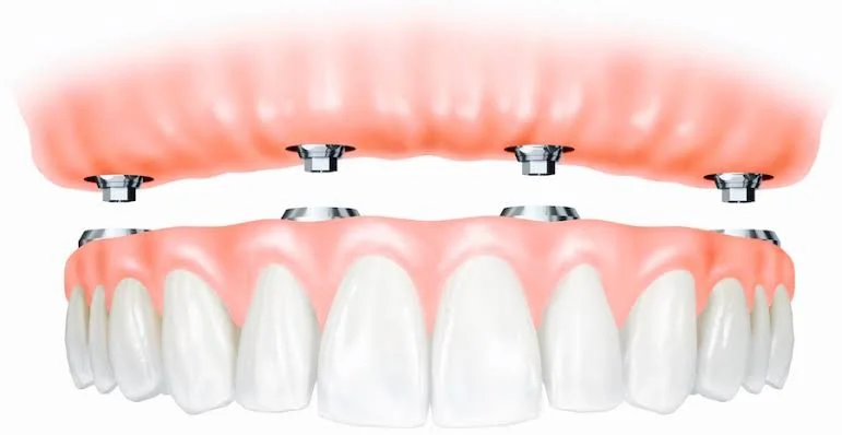 Fixed & Implant Dentures in Kota - Dentafusion Dental Clinic