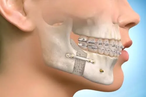 Jaw Correction & Surgery in Kota - Dentafusion Dental Clinic