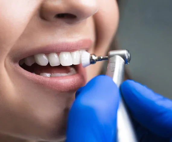 Teeth Whitening & Scaling in Kota in Kota - Dentafusion Dental Clinic