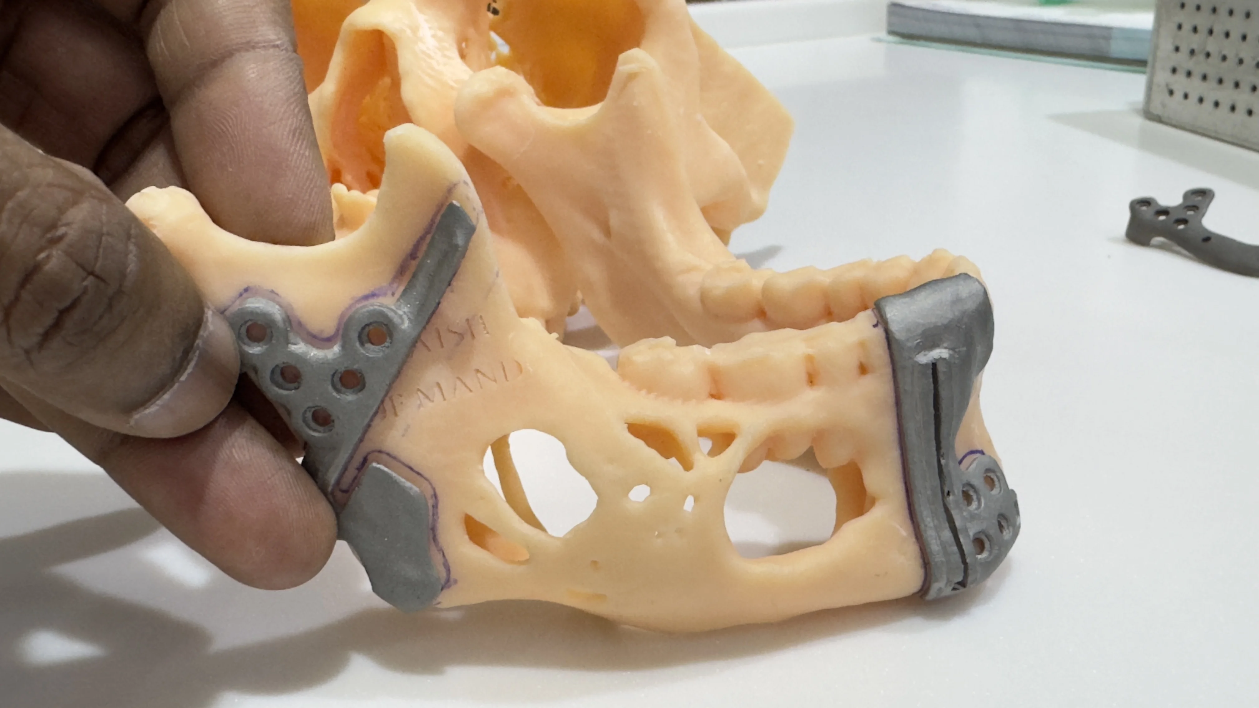 Total Joint Replacement Surgeries in Kota - Dentafusion Dental Clinic