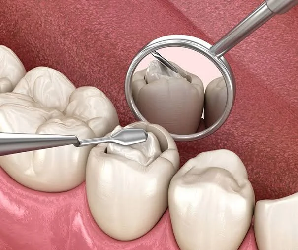 Tooth Fillings & Cavity Repair in Kota - Dentafusion Dental Clinic