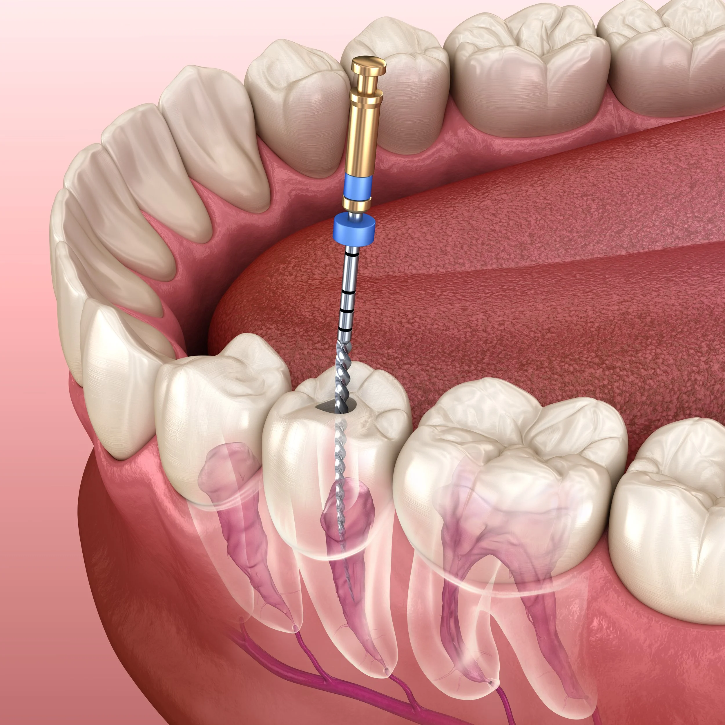 Root Canal Treatment in Kota in Kota - Dentafusion Dental Clinic